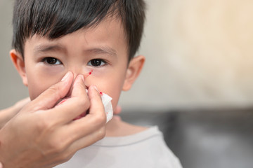 Portrait of cute Asian ethnic child having nosebleed,The concept of first aid for nosebleeds.