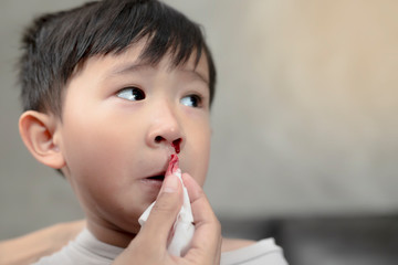 Portrait of cute Asian ethnic child having nosebleed,The concept of first aid for nosebleeds.