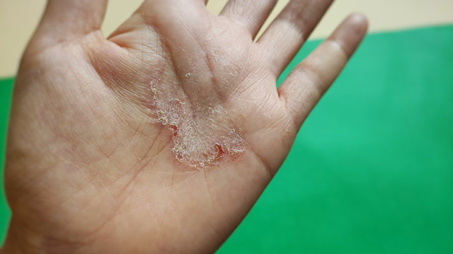 Healthcare Concept - Worsen Skin Rash On Palm