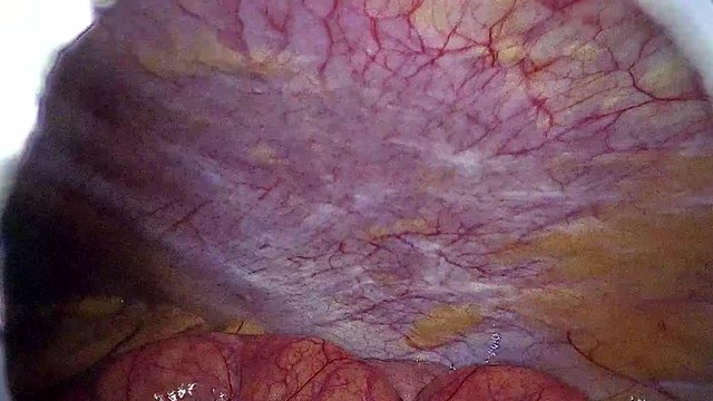 Appendicitis Surgery. View from the surgical camera of the process of removing Appendix_part02