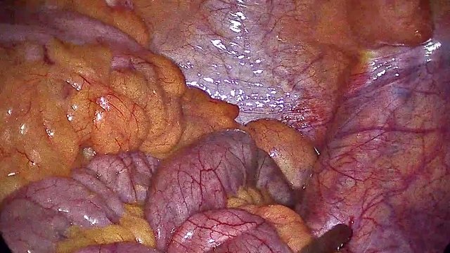 Appendicitis Surgery. View from the surgical camera of the process of removing Appendix_part10