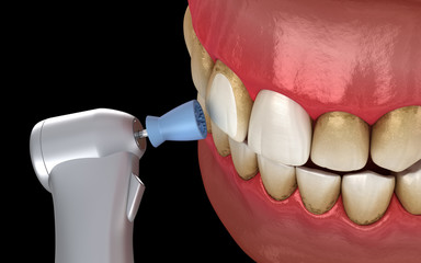 Teeth polishing procedure with professional brush and gel. Medically accurate 3D illustration