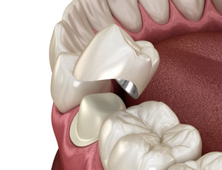 Preparated premolar tooth and dental metal-ceramic crown. Medically accurate 3D illustration