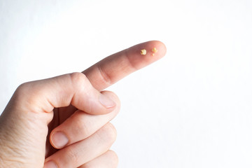 Tonsillolith (caseum) on index finger isolated on white background. Tonsil stones are hard deposits of debris that have lodged in tonsils.