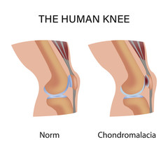 Chondromalacia. Pain in the joint. degenerative joint disease. The cartilage becomes worn out. This leads to inflammation, swelling, and joint pain. - obrazy, fototapety, plakaty