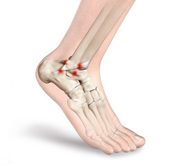 Torn ligament in ankle, 3D illustration