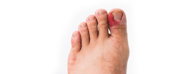 Close up of ingrown toenail is Inflamed fingernails isolated on white background. Health care and...