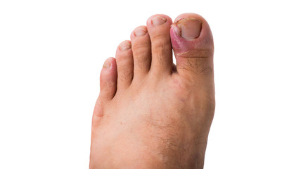 Close up of ingrown toenail is Inflamed fingernails isolated on white background. Health care and Foot disease concept