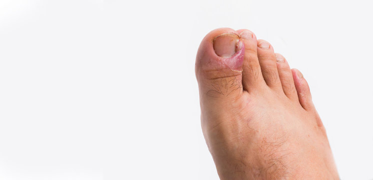 Close up of ingrown toenail is Inflamed fingernails isolated on white background. Health care and Foot disease concept