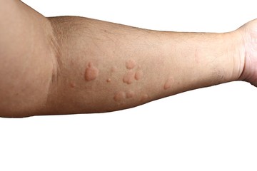 Urticaria on arm of a man.