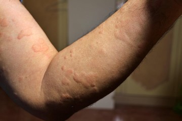 Urticaria on arm of a man.