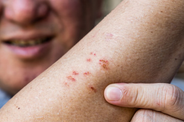 Naklejka premium Person embracing wound on skin a result of scratching due to itchy allergy