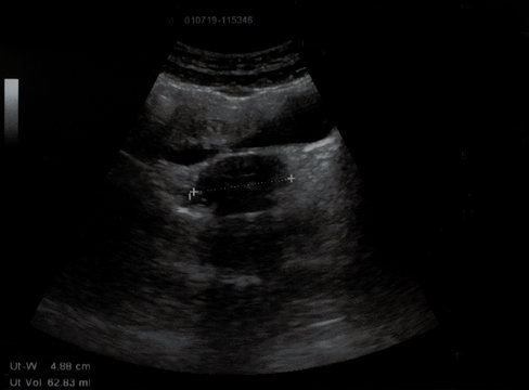 Film Ultrasound. Ovary,Internal Organs Examination For Women