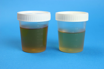 Urine samples in containers on a blue background