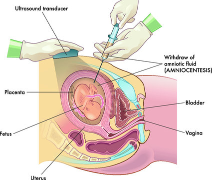 Medical illustration  of Amniocentesis procedure with annotations