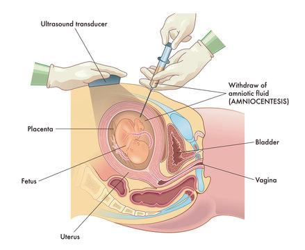 Medical illustration  of Amniocentesis procedure with annotations.