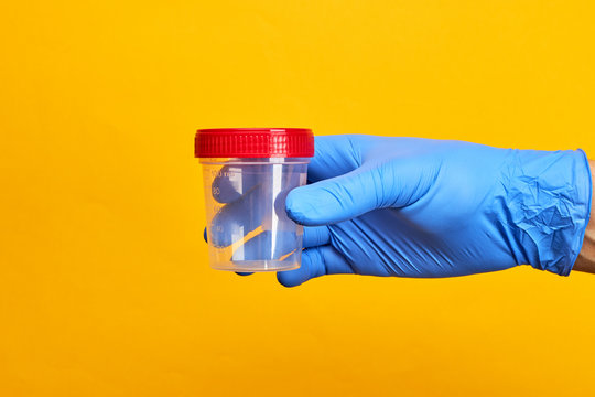 medical exam concept. person holds urine test cup over bright yellow background.