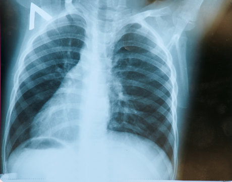 A typical chest x-ray in a direct projection of a patient with pneumonia. X-rays of light.