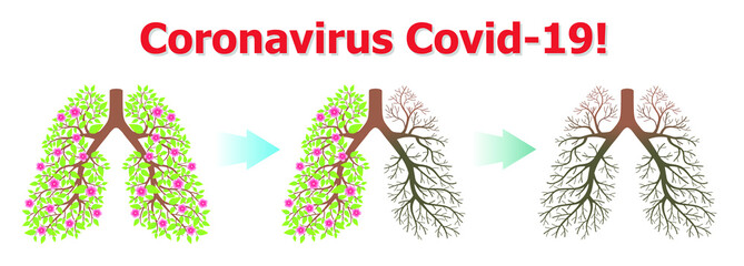 Coronavirus. Stages of pneumonia