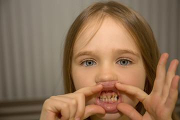 Little girl has blond hair, blue eyes, shows her rotten teeth