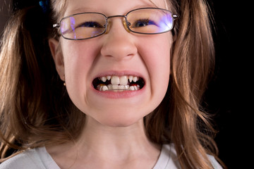 Little girl shows crooked teeth on a black background.