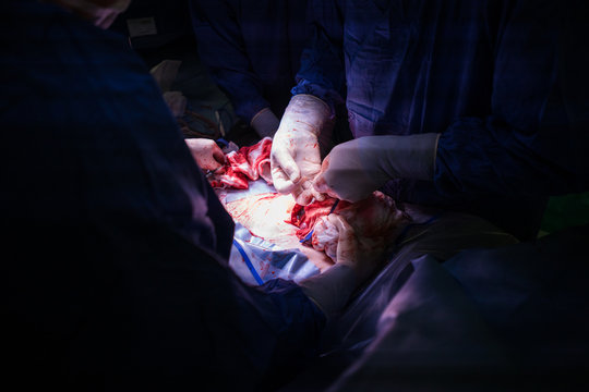 Doctors performing a caesarian section in an operating theater in a hospital