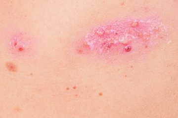 skin rash treatment on woman body. Shingles, Disease, Herpes zoster, varicella-zoster virus. skin...