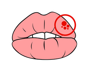 herpes simplex virus