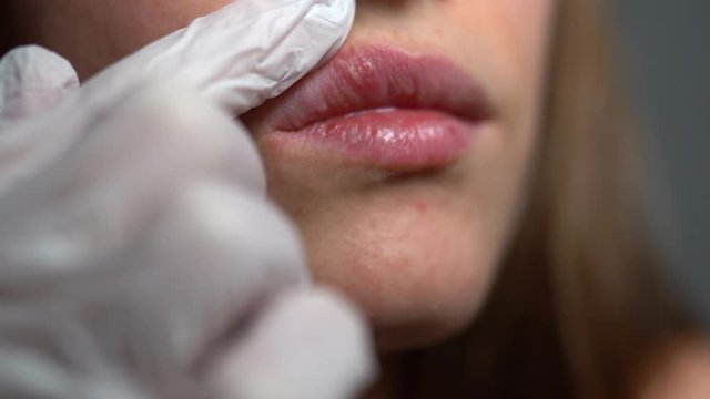 Young woman suffering from herpes sore on her lips, doctor in protective latex gloves examining female's upper lip with viral inflammation. Herpes sores appearing, infection inside the human body