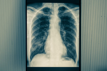 x ray image of a chest on coronavirus covid19 concept