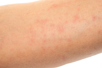 Closeup image of a male body suffering from chronic skin rash. Food allergy rash.