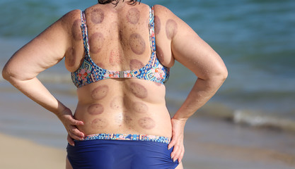 Woman with back marks from medical therapy.