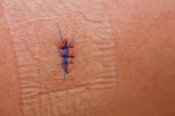 Wunde Naht K&ouml;rper 