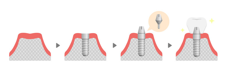 Dental implant process flat vector illustration (no text) - obrazy, fototapety, plakaty