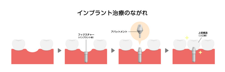 歯肉炎 歯周病のステージと症状イラスト Wall Mural Barks 歯肉炎 歯周病のステージと症状イラスト Wall Mural Barks