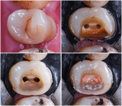 Root Canal Treatment Under Dental Microscope