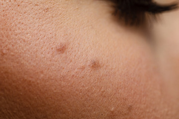 Part of woman face with mole close up