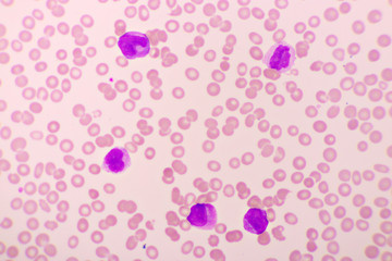 Acute promyelocytic leukemia cells or APL, analyze by microscope, original magnification 1000x