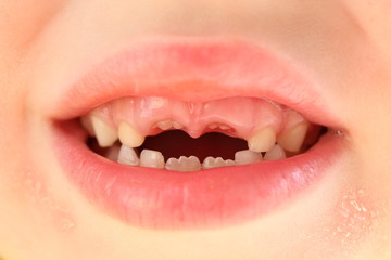 Naklejka premium Smile baby girls. Loss of front upper milk teeth and growth of new adult incisor, molar. Oral care in children. Dryness and peeling of skin around and in corners of mouth.