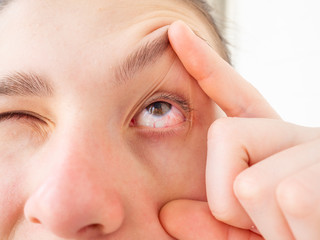 Close up red eye of teenage girl or young woman with conjunctivitis or allergies