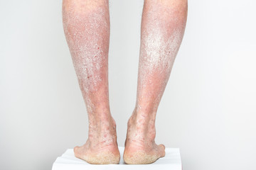 Acute psoriasis on male legs and heels is an autoimmune incurable dermatological skin disease. Large red, inflamed, flaky rash on the legs.