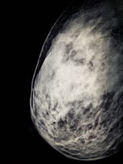 X-ray of a female breast