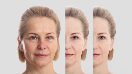 Face without makeup. Middle age close up woman face before after cosmetic. Skin care for wrinkled...