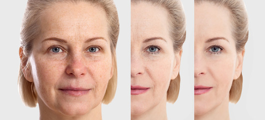 Face without makeup. Middle age close up woman face before after cosmetic. Skin care for wrinkled...