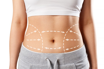 woman body with marks on stomach. liposuction, surgical removal of excess fat from the abdomen