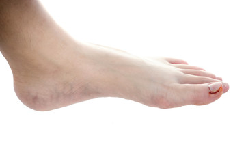 foot with ingrown nail, treatment of ingrown toenail and toe with infected tissue and pus pocket