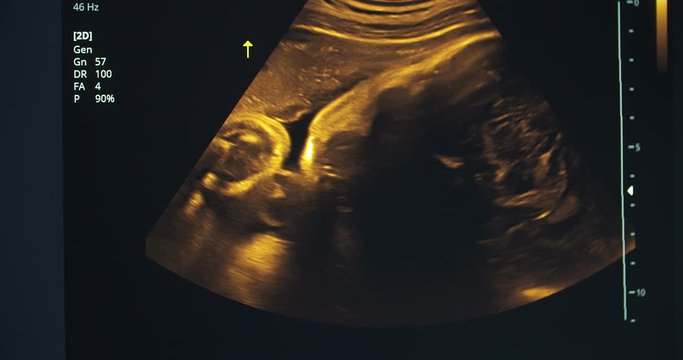 Sonography or medical ultrasound examination of a 36-week-old fetus.