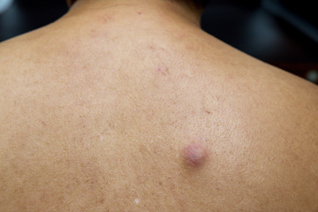 Fototapeta premium Big red pimple on man back, look like an abscess