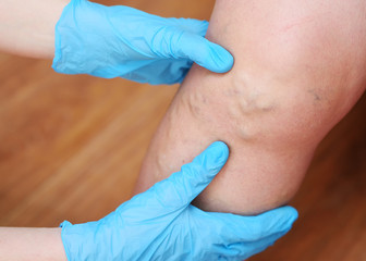 the doctor's hands in rubber gloves examine the varicose veins on the patient's legs in close-up.