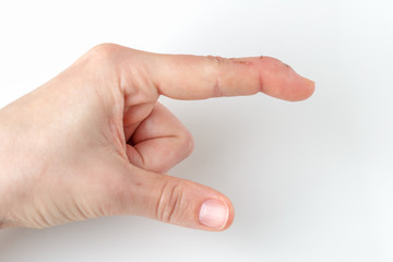a cut index finger with a extensor tendon injury, mallet finger, tip of finger bending downwards...